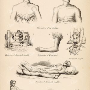 ANATOMY - Illustrations Depicting Dislocations - Antique 1880 Illustration