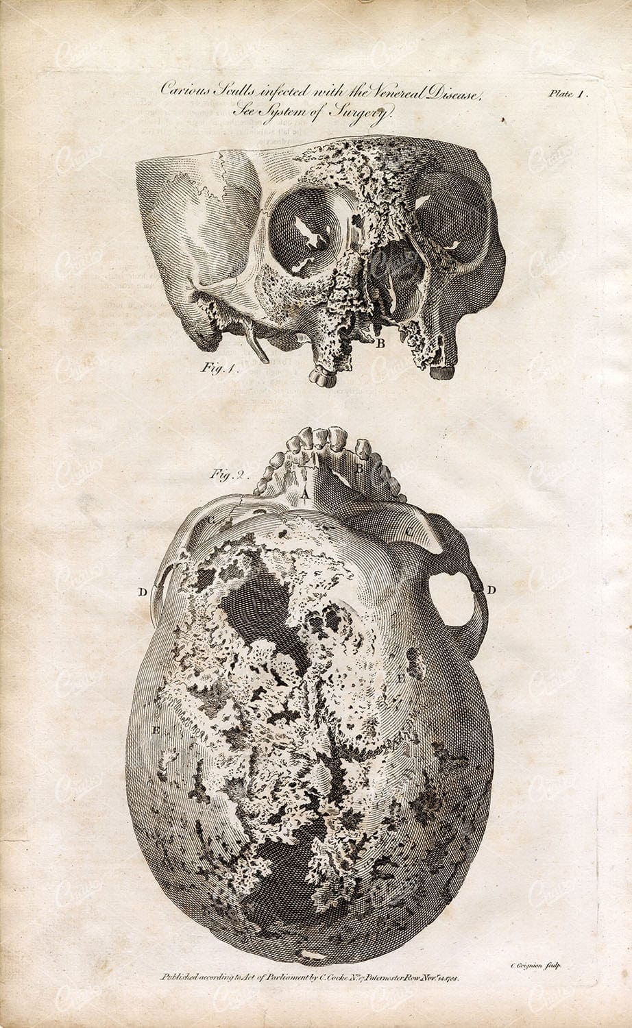 HUMAN ANATOMY - Skulls Infected with the Venereal Disease - 1791 Print