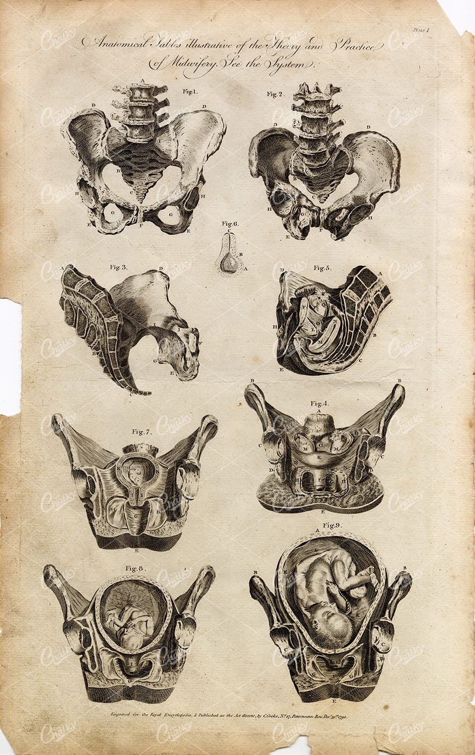 MIDWIFERY - Anatomy of Baby, Pelvis, & Womb - Antique 1791 Engraving