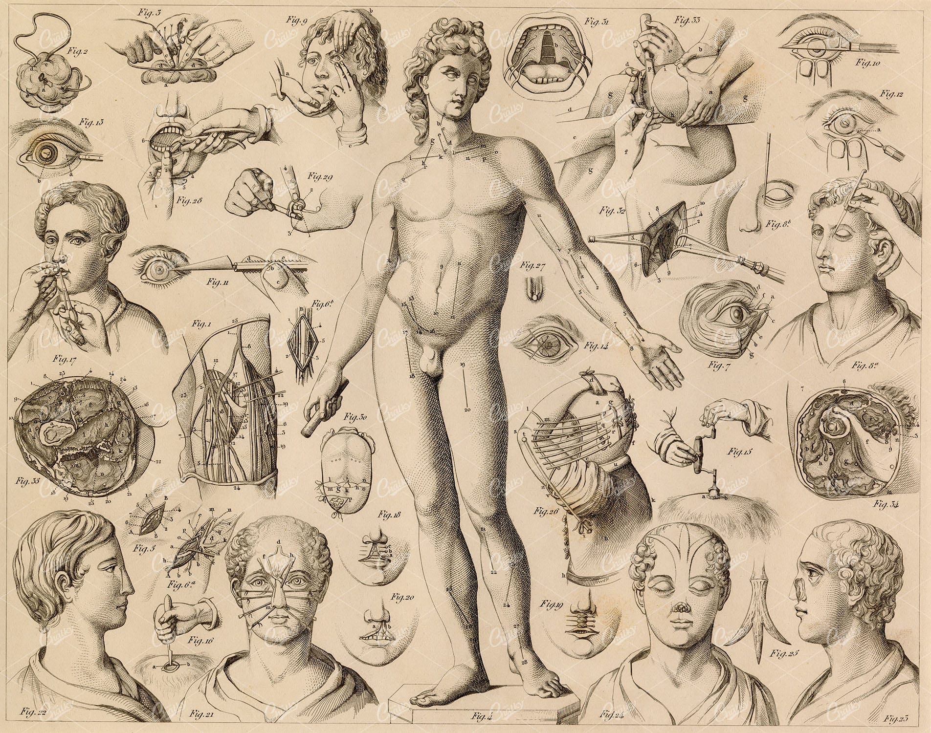 SURGERY - Various Surgical Operations on Humans - Antique 1851 Print